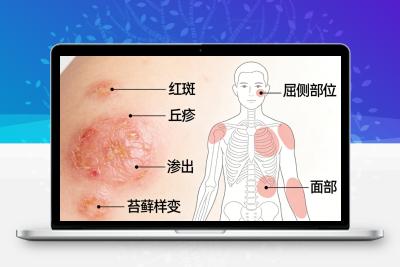 特应性皮炎：不只是皮肤问题，更是全身健康的信号